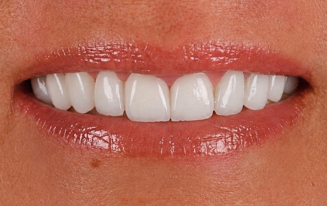 Buzëqeshja e të njëjtit pacient pas trajtimit në Doa Dentalcare, me dhëmbë të rregulluar dhe të bardhë